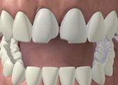 Исправление зубов